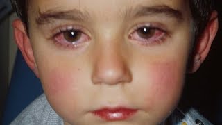 علاج احمرار العيون عند الأطفال والتهاب الملتحمة مع الدكتورة ديما عتوم