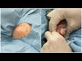 摘出困難例　炎症したことのある臀部の粉瘤　ブログでも詳しく解説してます。　ふるばやし形成外科粉瘤クリニック　東京新宿院　大阪梅田形成外科クリニック