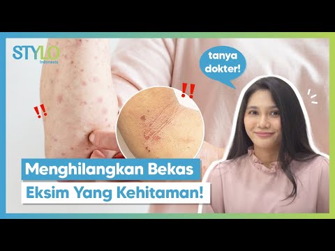 Video: 3 Cara Mengurangi Bekas Luka dari Eksim