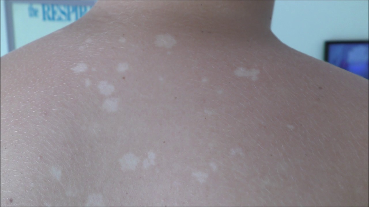 Tinea Versicolor White Spots On Skin