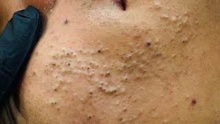 The Best Blackheads Removal | Facial Care Tips and Acne Treatment at Home #facialcare
