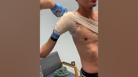 Transhumeral Prosthesis Casting Process