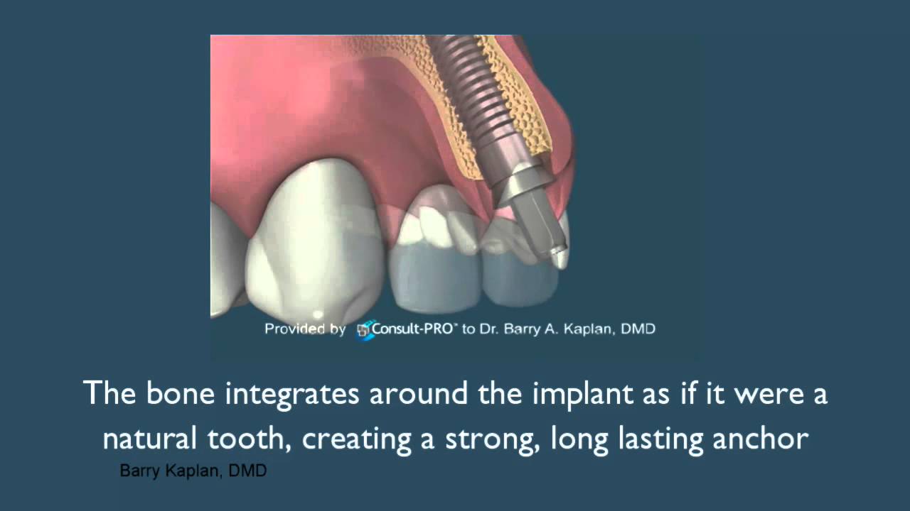 Dr. Barry A. Kaplan | Dental Implants Step by Step