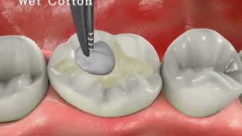 Spident Temp it από την DNNDental