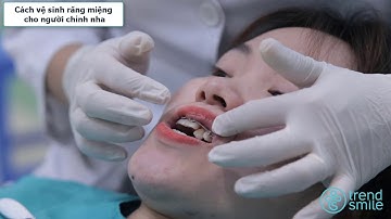 Cách vệ sinh răng miệng cho các bạn đang đeo mắc cài - chỉnh nha