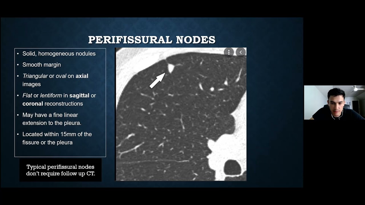 Pedro Gonzalez Mantilla, MD - Incidental Pulmonary Nodules