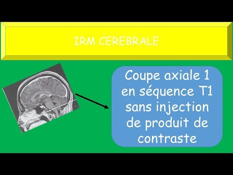 IMAGERIE MEDICALE - IRM CEREBRALE - Coupes axiales sans injection de produit de contraste