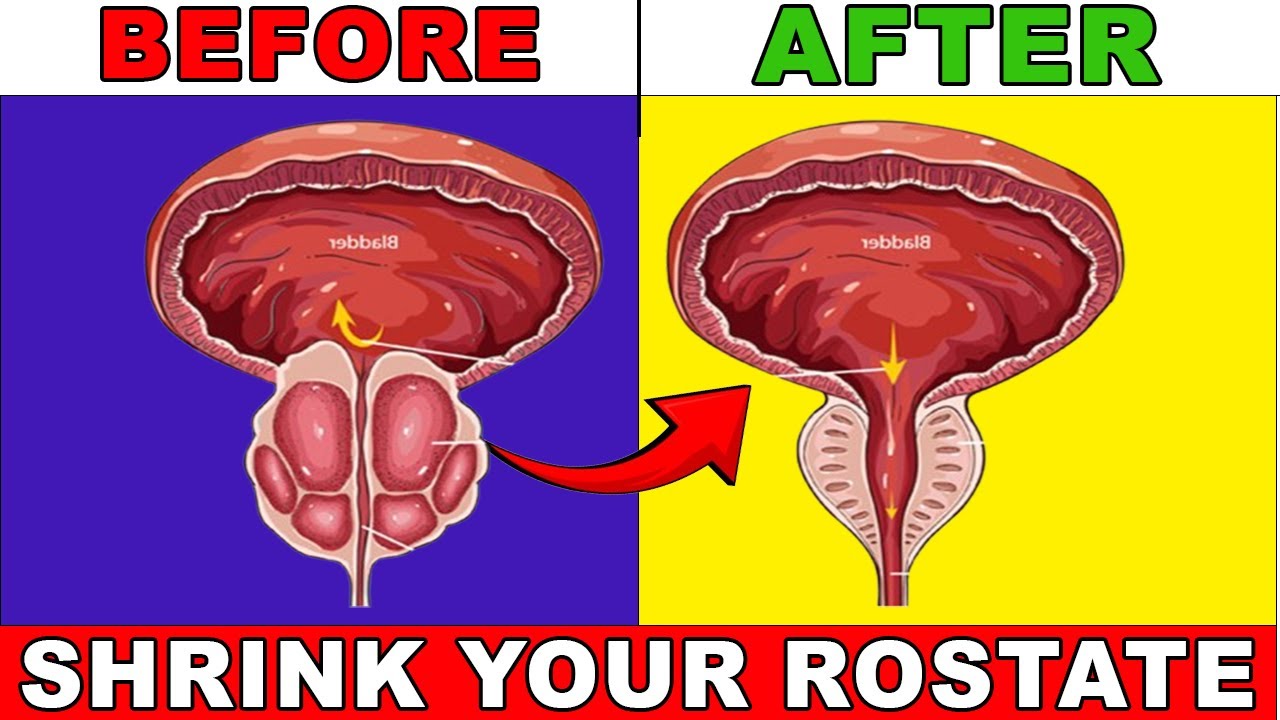 No.1 Vitamin to SHRINK an ENLARGED PROSTATE | 1 Vitamin Help Shrink Your Prostate by Dr. Vivek Joshi