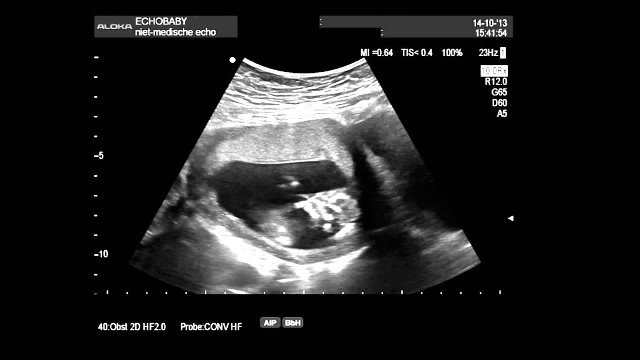 Echo geslachtsbepaling 13 weken meisje, met ingesproken uitleg YouTube Echo geslachtsbepaling 13 weken meisje, met ingesproken uitleg YouTube