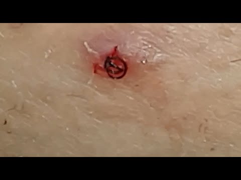 #8 Ingrown hair removal