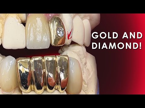 How to create a Gold and Diamond Restoration