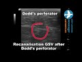 Racanalisation GSV after Dodd's perforator
