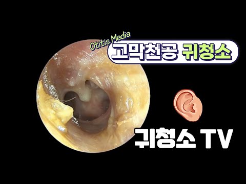 고막천공 중이염 귀청소