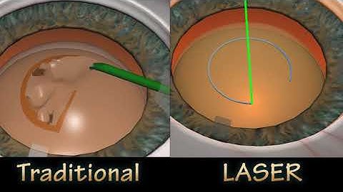 FLACS VS TRADITIONAL CATARACT SURGERY -  Rhexis Compare