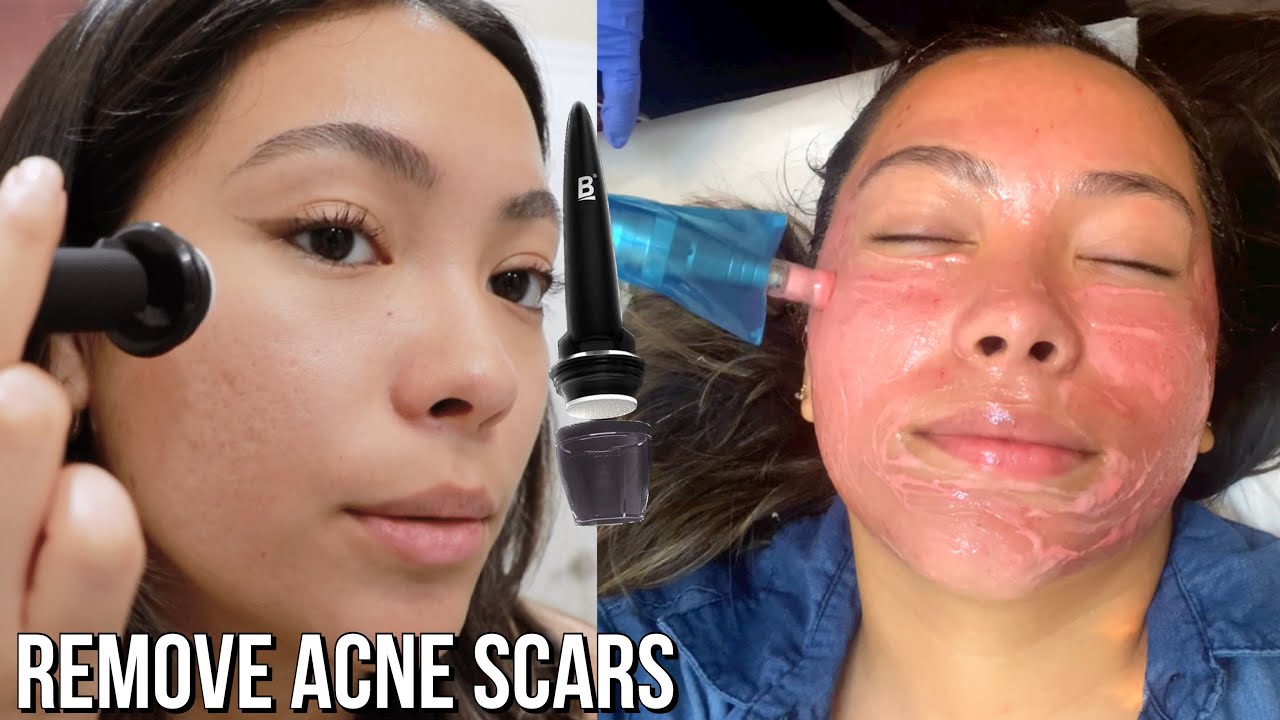 At-Home Microneedling vs In-Office Microneedling | What's the difference?