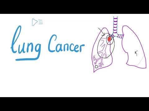 Lung Cancer | The most COMPREHENSIVE Explanation