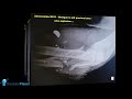 GUNSHOTS AROUND THE ELBOW - TIPS AND TRICKS FOR SUCH UNUSUAL FRACTURE SCENARIOS