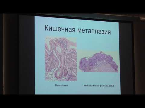 60 Беляков ММ Атрофический гастрит, кишечная метаплазия и дисплазия взгляд патоморфолога