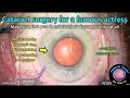 Cataractcoach 2185 surgery for a famous actress