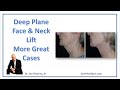 Deep Plane Facelift: More Great Cases