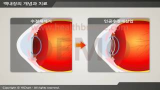 [시연용] a0021aako 백내장의 개념과 치료