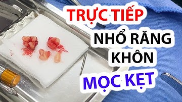 Trực tiếp nhổ răng khôn khôn - Mọc lệch và kẹt vào răng số 7