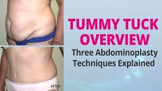 Tummy Tuck Overview - Three Abdominoplasty Techniques Explained - Edelstein Cosmetic - Toronto