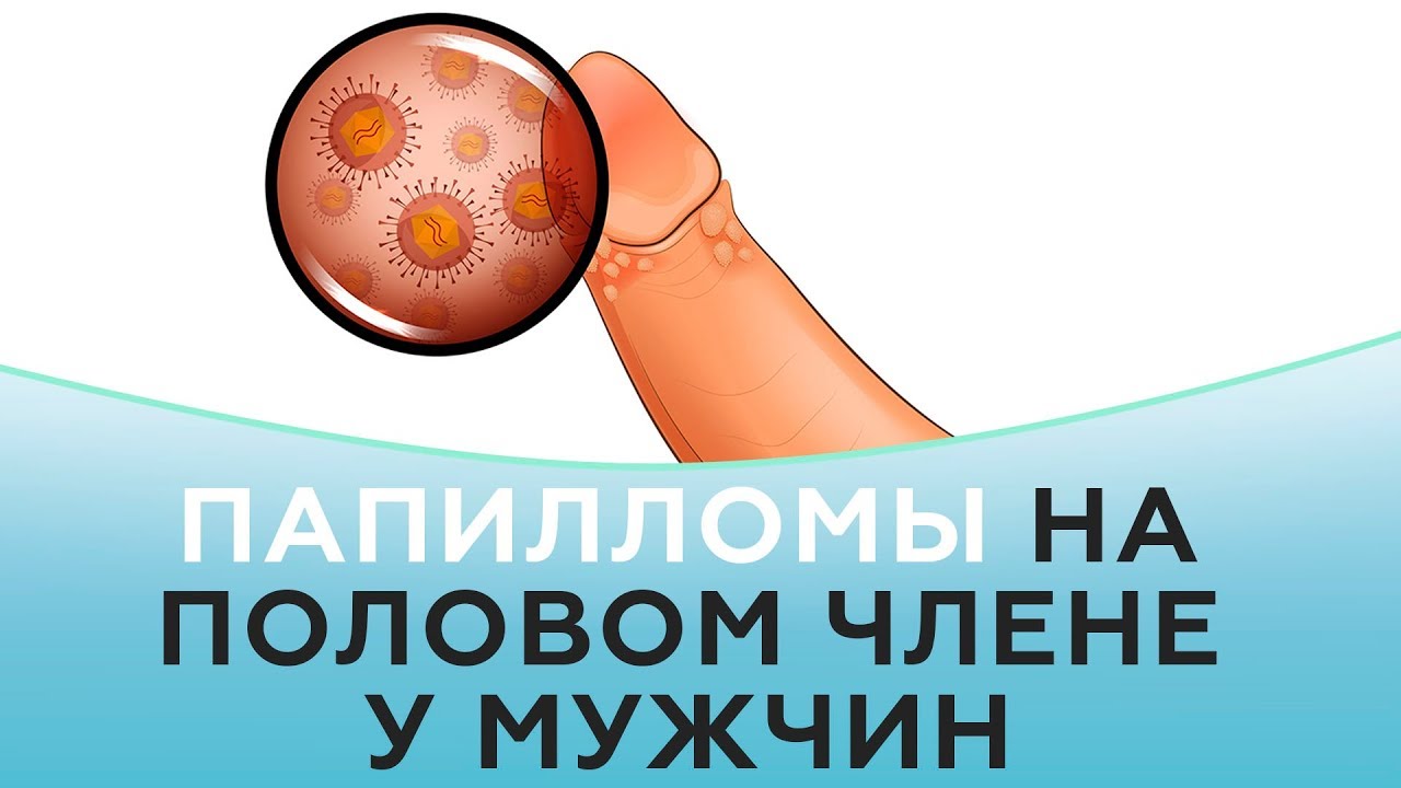 Humán papillómavírus (HPV) fertőzés és megelőzése - Mamadoki Nőgyógyászati Magánrendelő