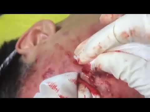 HUGE CYSTIC ACNE EXTRACTION #