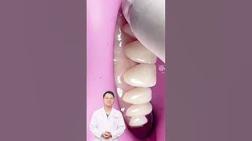 Quá Trình Lắp Những Chiếc Răng Nhân Tạo |Dr Cường Offical #rangsuthammy #bacsicuongrangsu #caurangsu