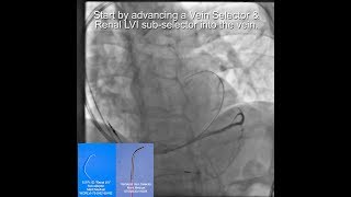 Difficult Case made Easy Large PL No Options Case Example apr18raemcg WITH Audio 1May18