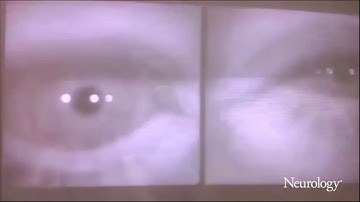 Blink-associated contralateral eccentric saccades as a rare sign of unilateral brain injury [2/2]