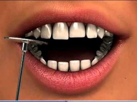 Dentistry Recontouring Teeth 1