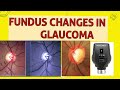 Optic disc changes in glaucoma