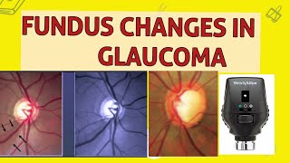 OPTIC DISC CHANGES IN GLAUCOMA