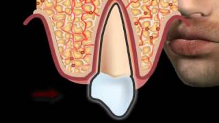 What Are Receding Gums?