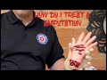 How to treat an amputation. What do I do with an amputated body part