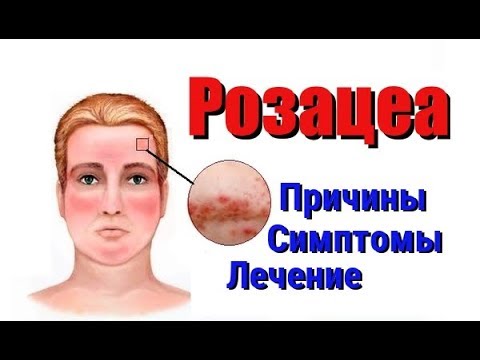 Розацеа. Лечение