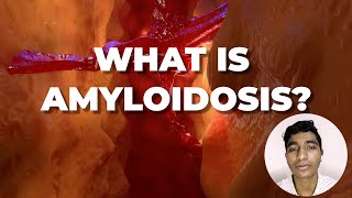 Decoding Amyloidosis: Causes, Types, and Symptoms | Dr. Barclay Karnatki