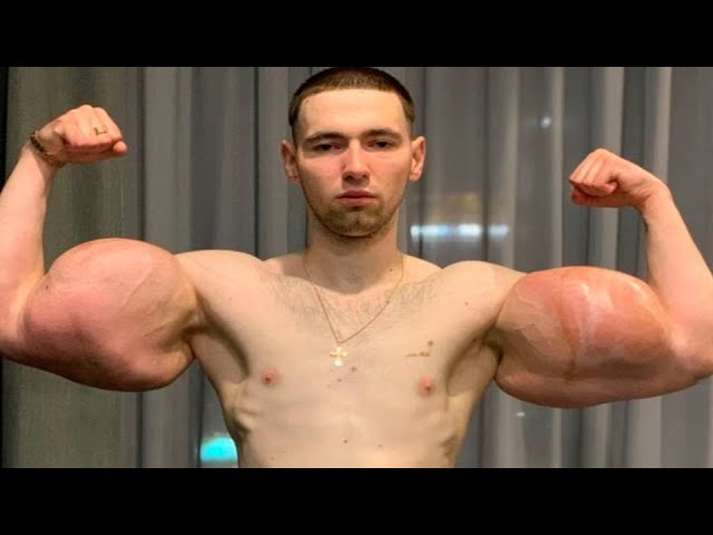 Russian 'Popeye' has 3 pounds of 'dead' muscle removed after DIY  bodybuilding injections