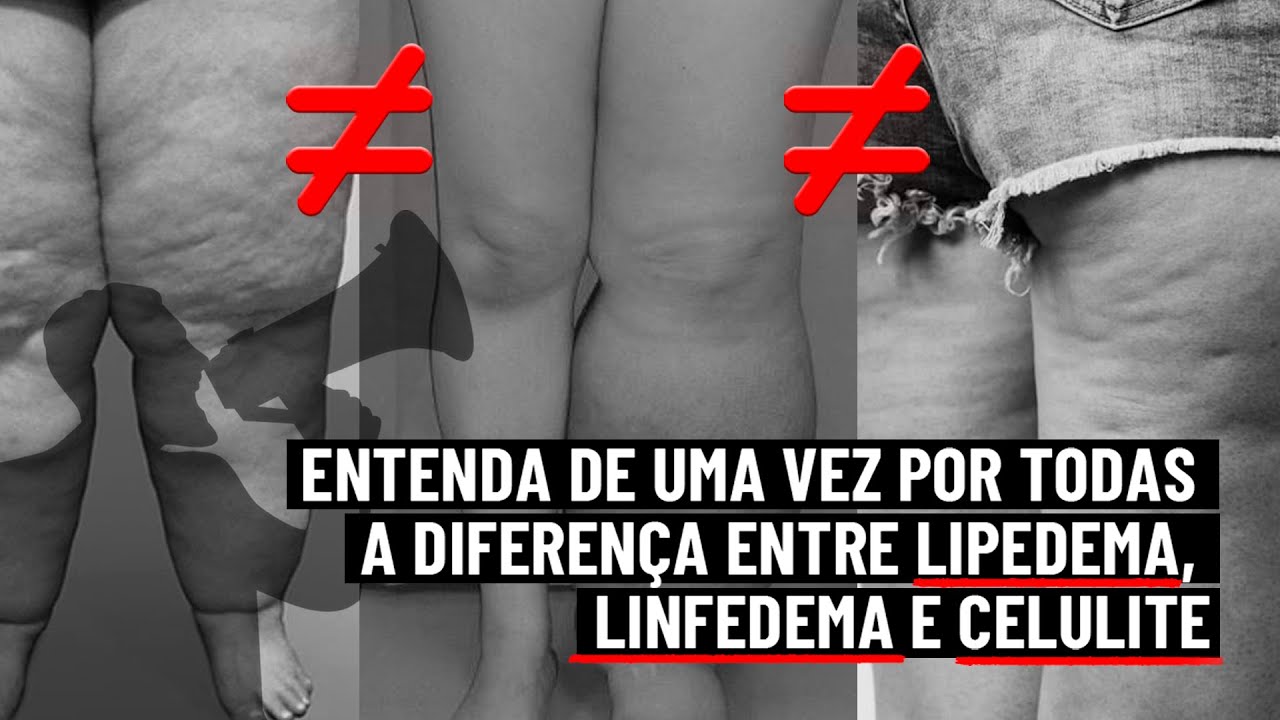 Entenda a diferença entre lipedema, linfedema e celulite 