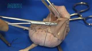 Ileocystoplasty