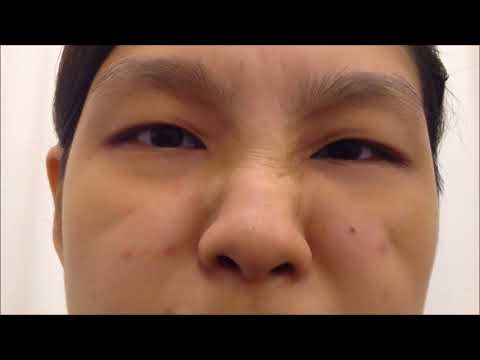 Physiotherapy - Bell&rsquo;s palsy | 物理治疗 — 贝尔氏麻痹症