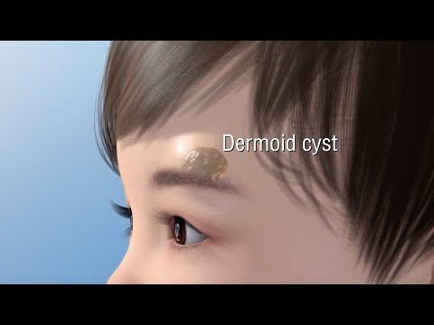 Видео: Нэг нүдтэй уйланхай гэж юу вэ?