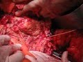 Supra renal aaa sultan technique with aortoduodenal fistula