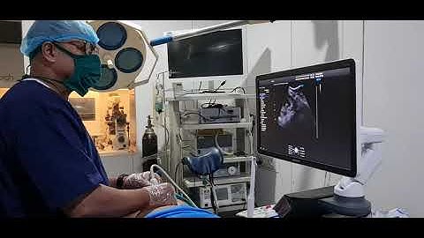 Chorion villus biopsy for prenatal diagnosis of FGFR3 gene mutation, previous child Achondroplasia.