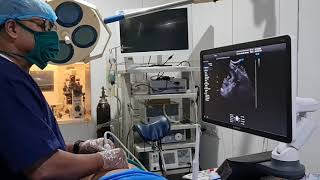 Chorion Villus Biopsy For Prenatal Diagnosis Of Fgfr3 Gene Mutation, Previous Child Achondroplasia.