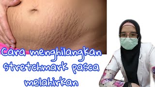 Cara mengatasi stretchmark  pasca melahirkan