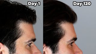 I put ROSEMARY OIL in My HAIR Everyday - 120 Day Results