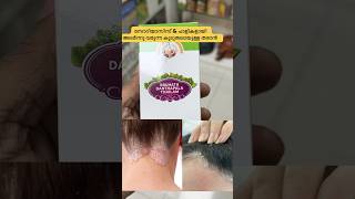 സോറിയാസിസ്, പാളികൾ ആയിട്ടുള്ള തരാൻ #dandruff #psoriasis #skininfection #herbaloil #tharan #uae #dxb